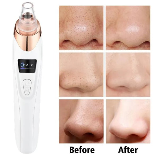 Blackhead Remover - Make your skin beautifull again!